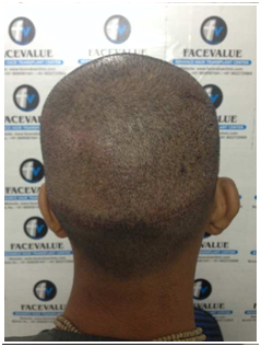 After-DHI-Direct-Hair -Implantation-Hair-Transplant-near-Malad-Face-Value-Clinic